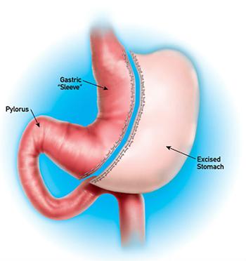 sleeve-gastrectomy-new.jpg.1e363ab7c33569238818b23be31df274.jpg